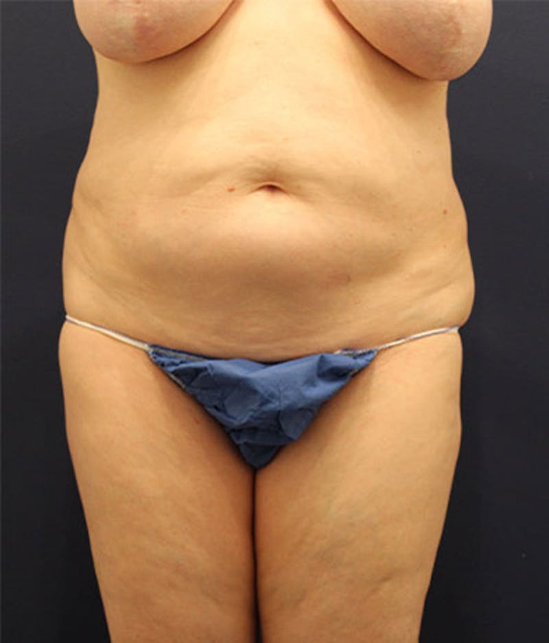 Tummy Tuck Before & After Gallery - Patient 174164397 - Image 1