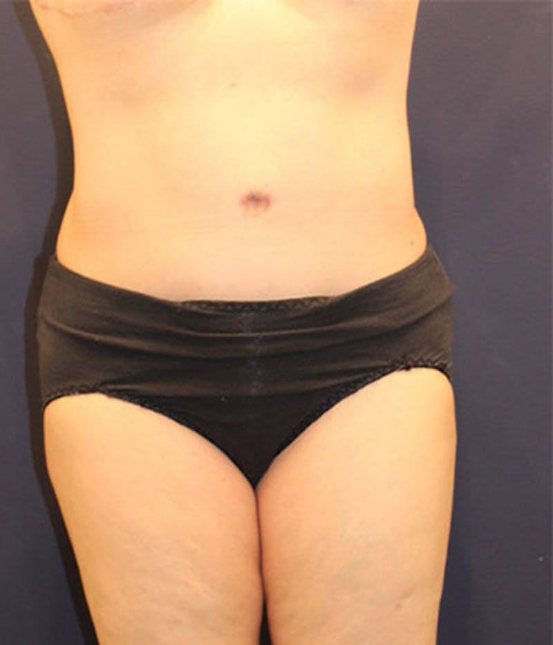 Tummy Tuck Before & After Gallery - Patient 174164397 - Image 2