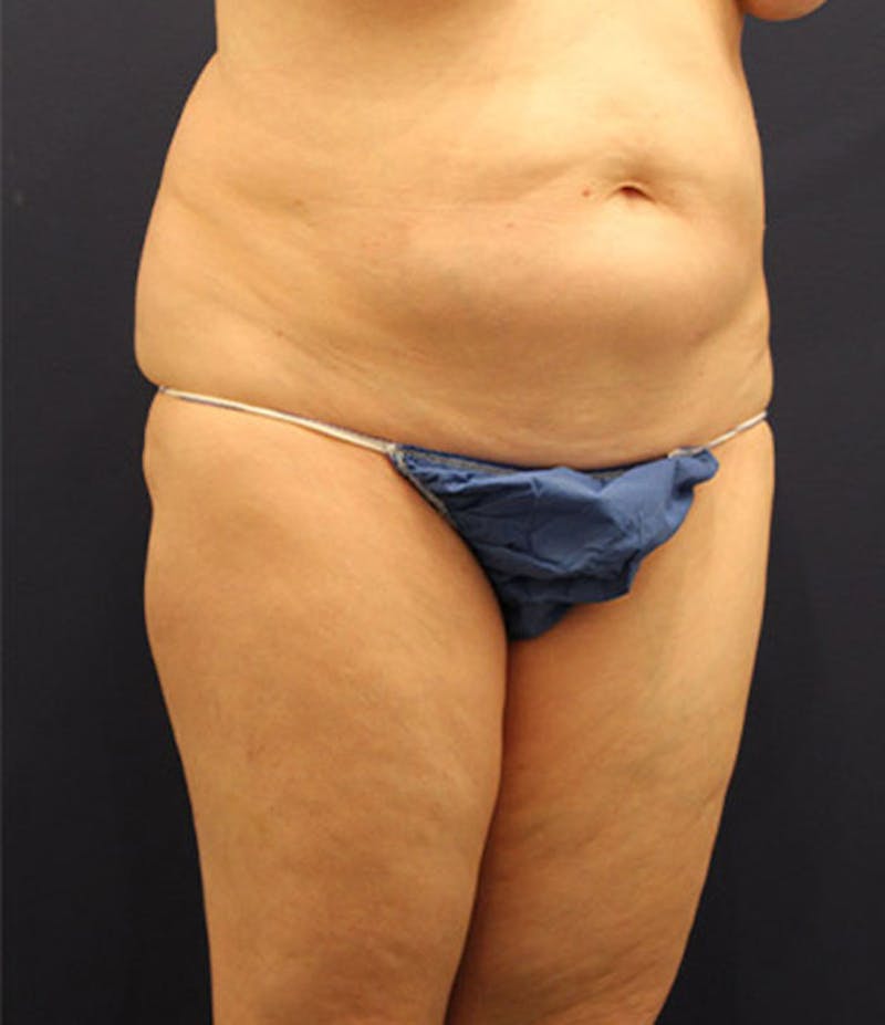 Tummy Tuck Before & After Gallery - Patient 174164397 - Image 3