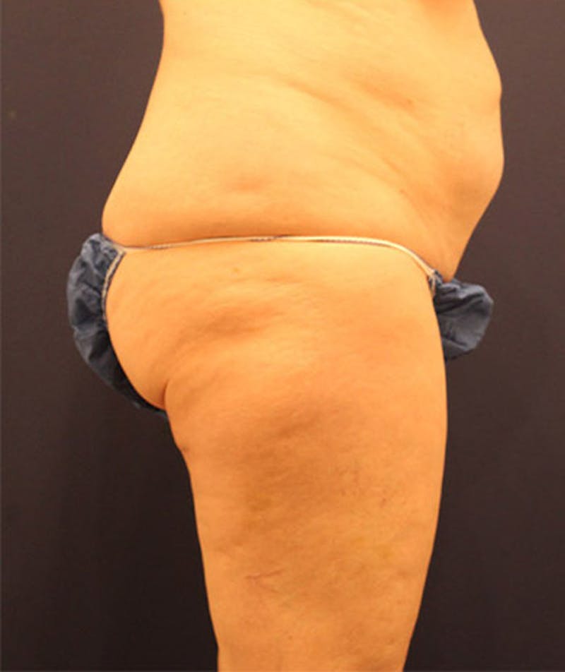 Tummy Tuck Before & After Gallery - Patient 174164397 - Image 4