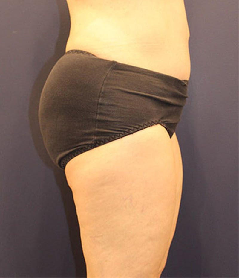 Tummy Tuck Before & After Gallery - Patient 174164397 - Image 6