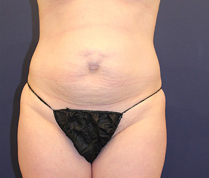 Tummy Tuck Before & After Gallery - Patient 174164404 - Image 1