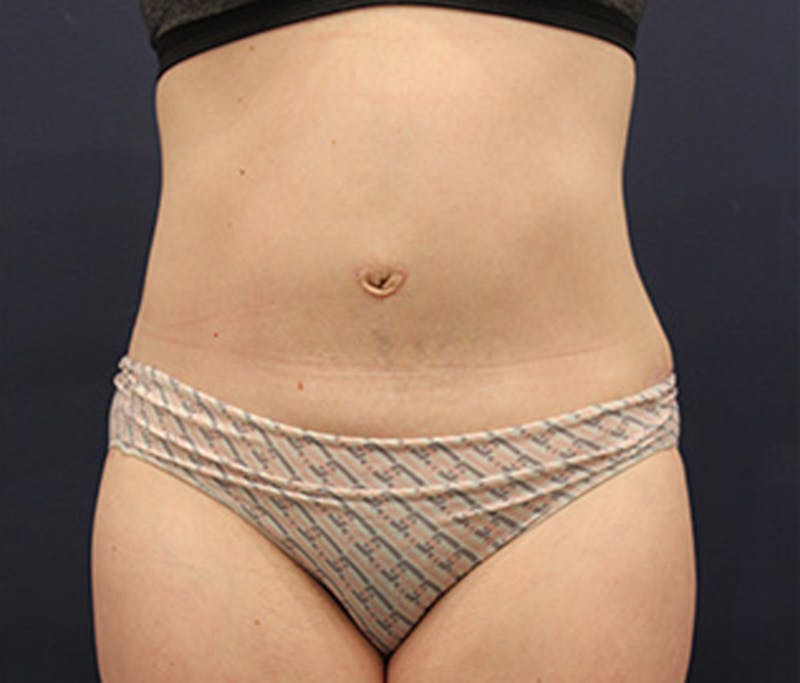 Tummy Tuck Before & After Gallery - Patient 174164404 - Image 2