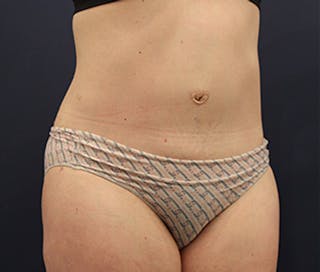 Tummy Tuck Before & After Gallery - Patient 174164404 - Image 4