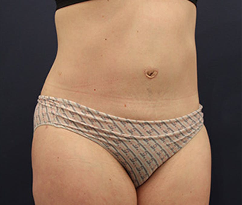 Tummy Tuck Before & After Gallery - Patient 174164404 - Image 4
