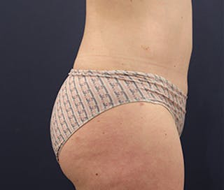 Tummy Tuck Before & After Gallery - Patient 174164404 - Image 6