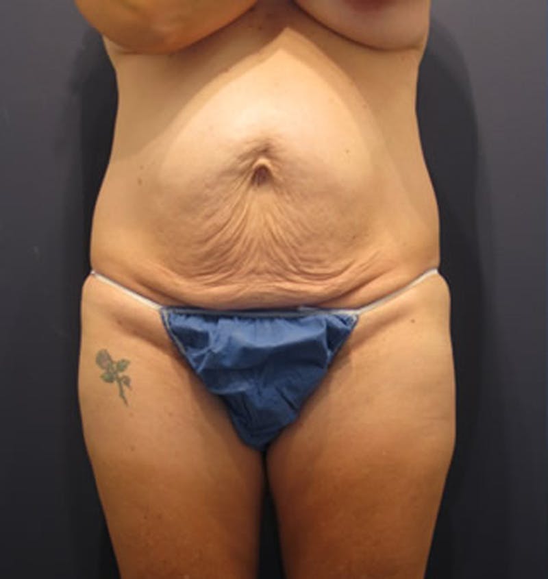 Tummy Tuck Before & After Gallery - Patient 174164411 - Image 1
