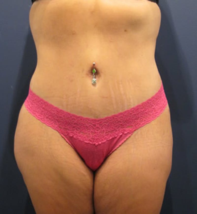 Tummy Tuck Before & After Gallery - Patient 174164411 - Image 2