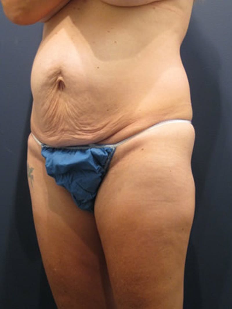 Tummy Tuck Before & After Gallery - Patient 174164411 - Image 3