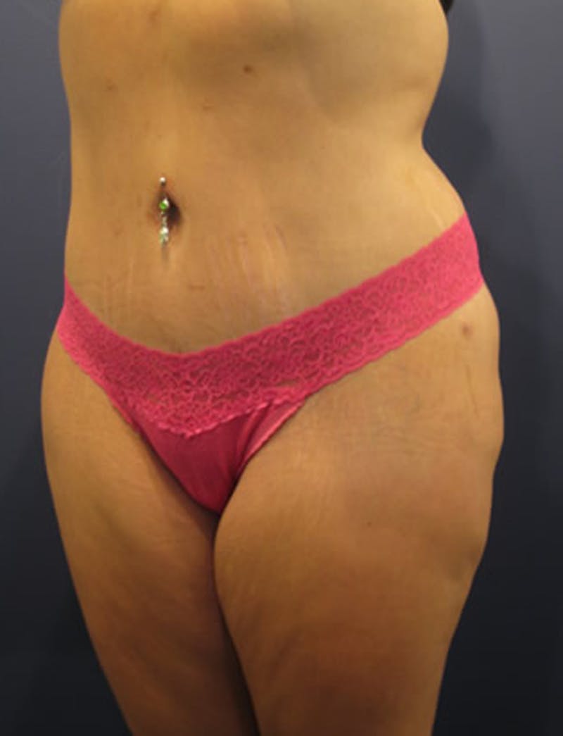Tummy Tuck Before & After Gallery - Patient 174164411 - Image 4