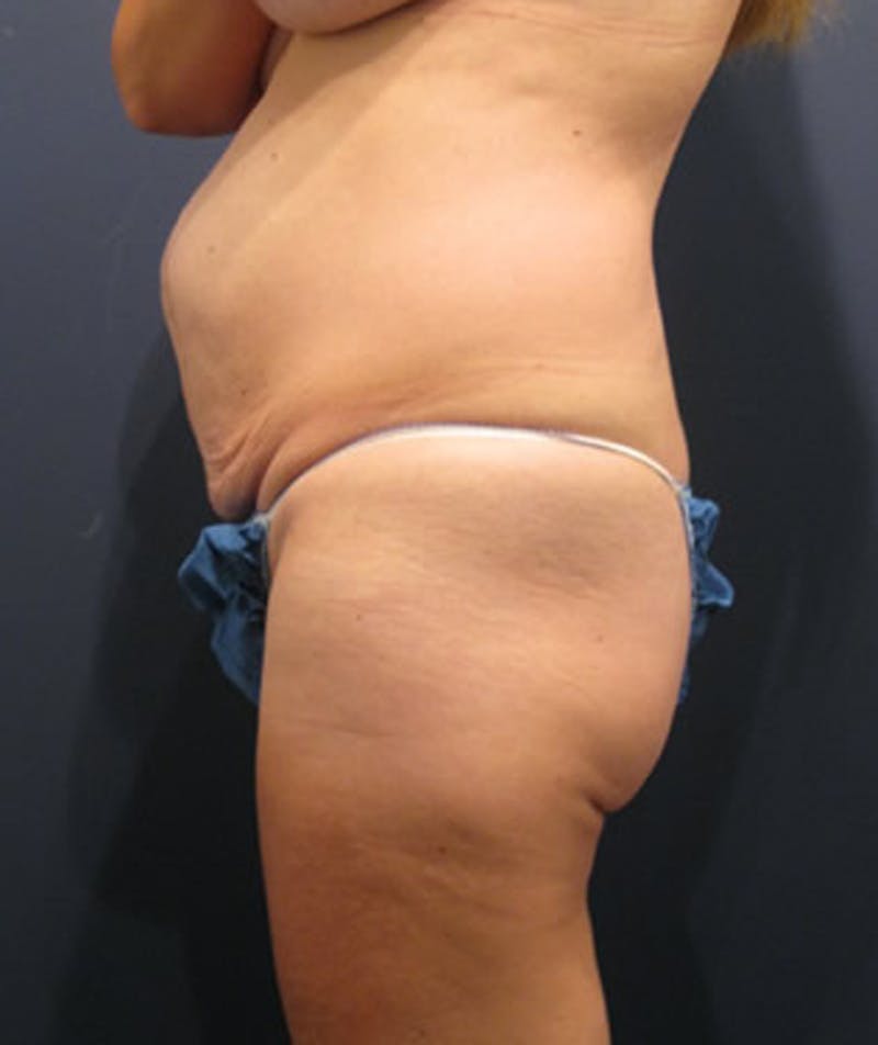 Tummy Tuck Before & After Gallery - Patient 174164411 - Image 5