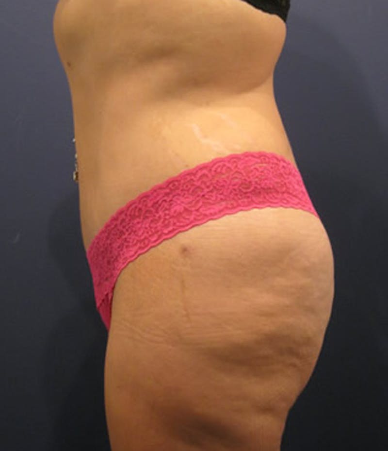 Tummy Tuck Before & After Gallery - Patient 174164411 - Image 6