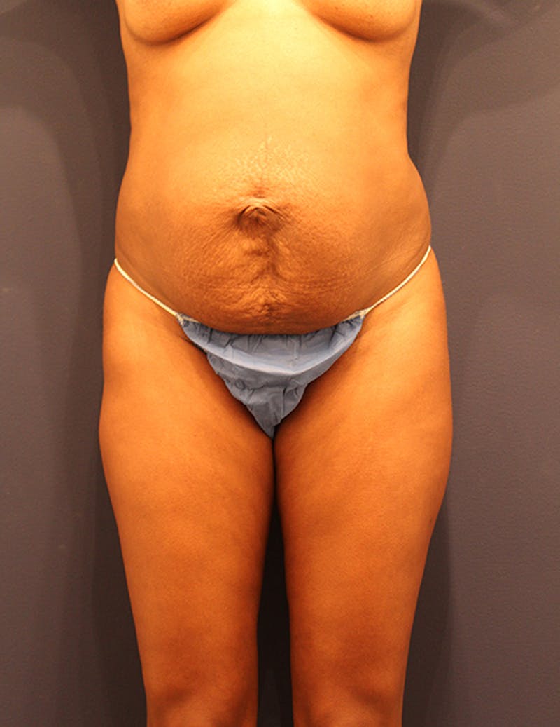 Tummy Tuck Before & After Gallery - Patient 174164422 - Image 1