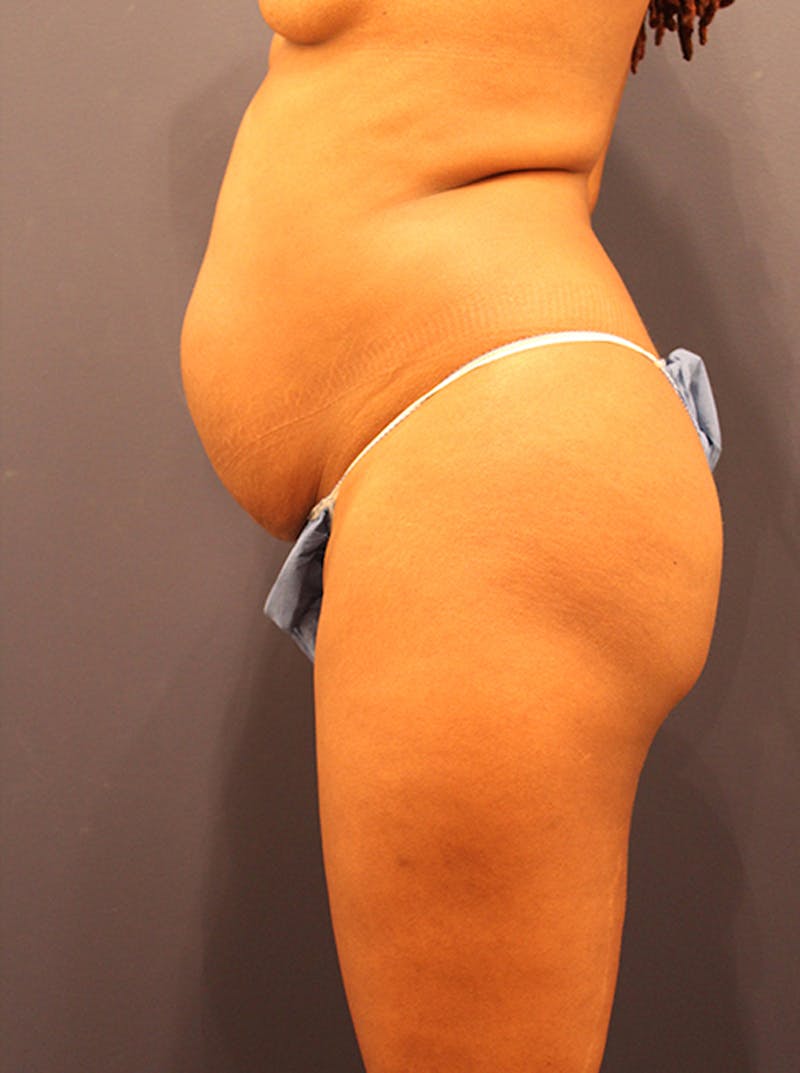 Tummy Tuck Before & After Gallery - Patient 174164422 - Image 3