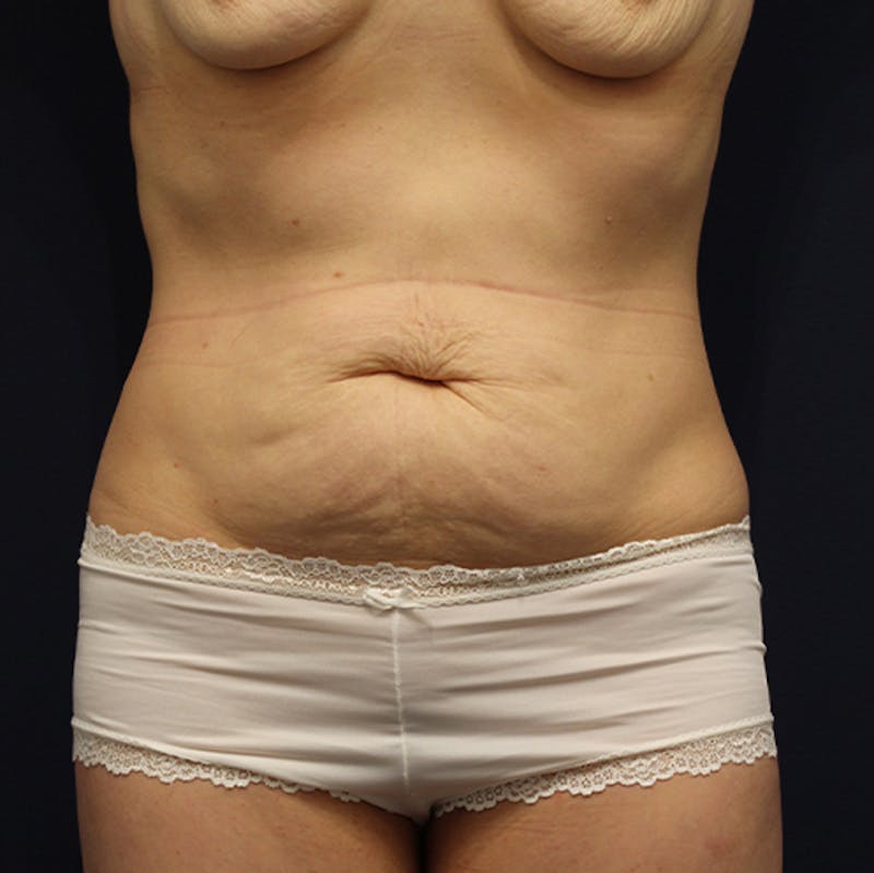 Tummy Tuck Before & After Gallery - Patient 174164433 - Image 1