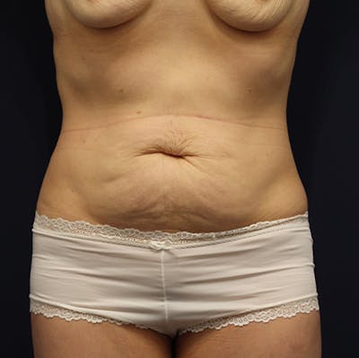 Tummy Tuck Before & After Gallery - Patient 174164433 - Image 1