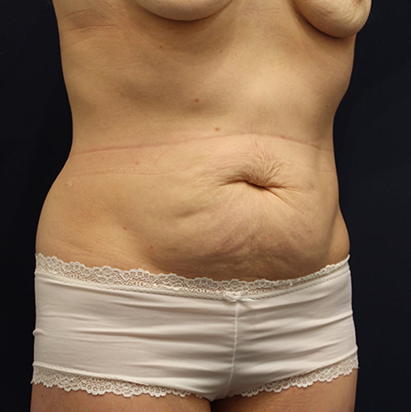 Tummy Tuck Before & After Gallery - Patient 174164433 - Image 3
