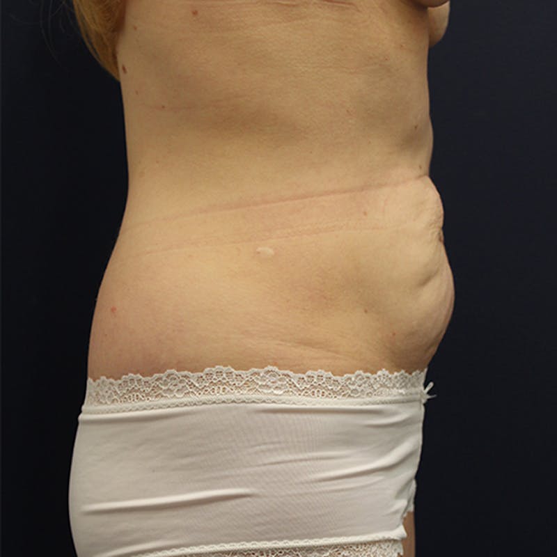 Tummy Tuck Before & After Gallery - Patient 174164433 - Image 5