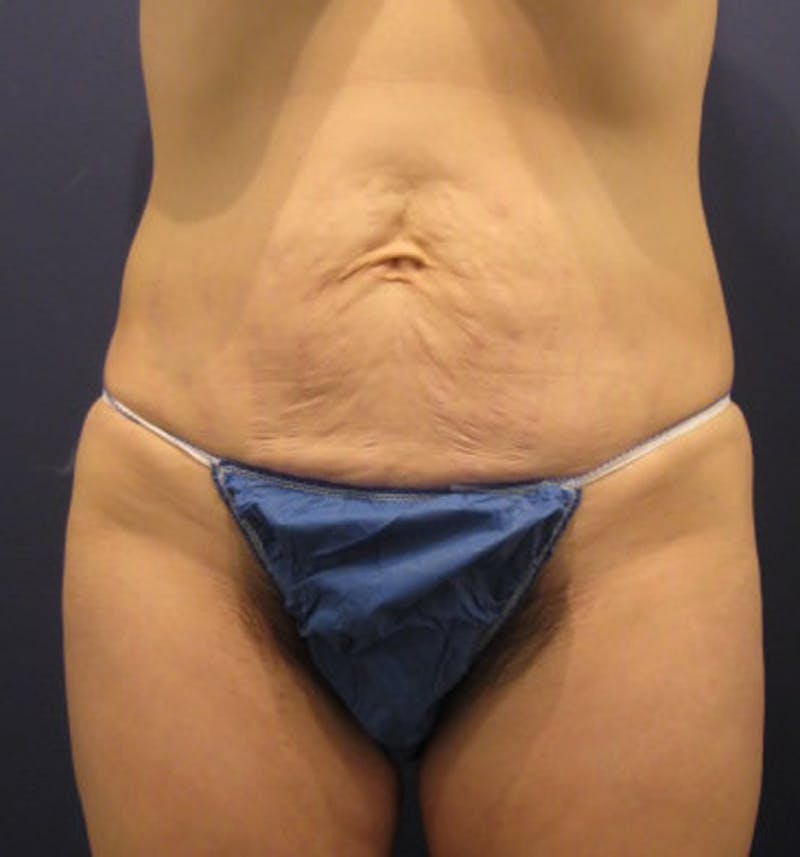 Tummy Tuck Before & After Gallery - Patient 174164436 - Image 1