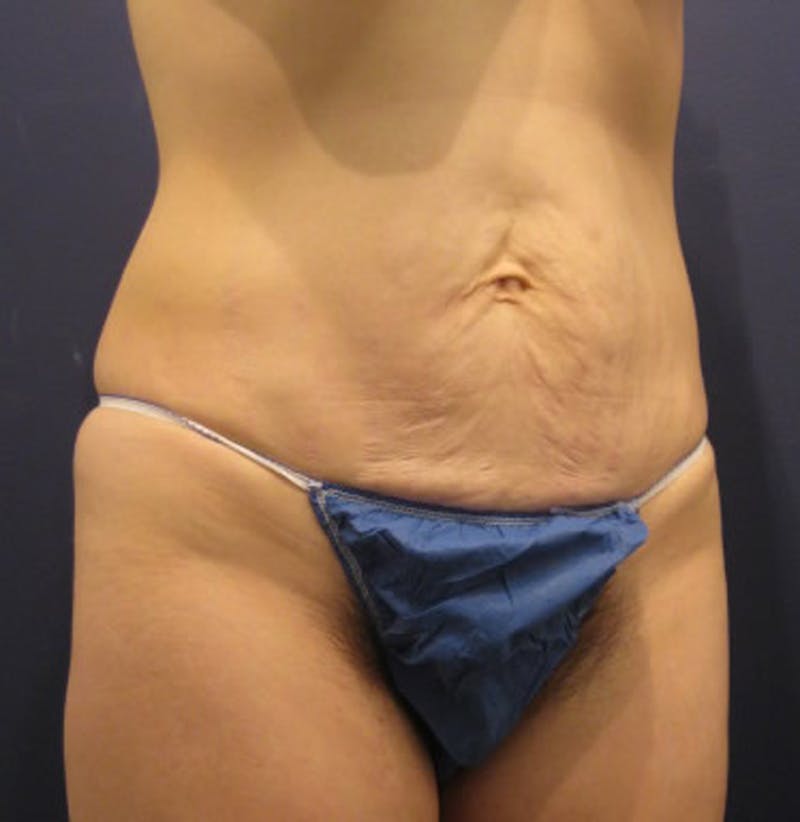Tummy Tuck Before & After Gallery - Patient 174164436 - Image 2