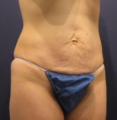 Tummy Tuck Before & After Gallery - Patient 174164436 - Image 2