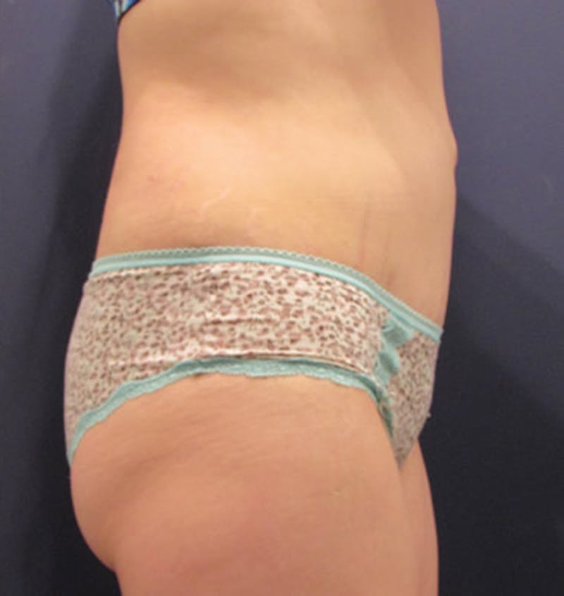 Tummy Tuck Before & After Gallery - Patient 174164436 - Image 5