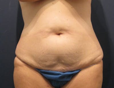 Tummy Tuck Before & After Gallery - Patient 174164440 - Image 1
