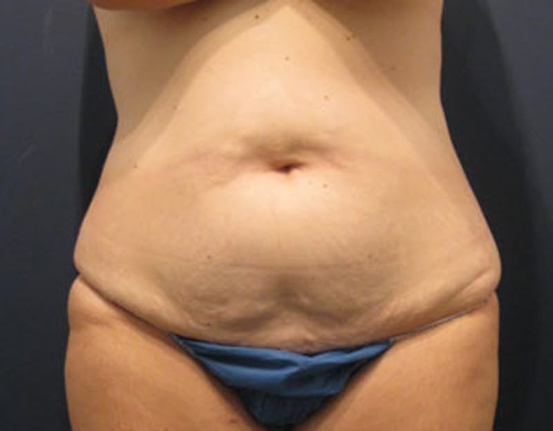 Tummy Tuck Before & After Gallery - Patient 174164440 - Image 1