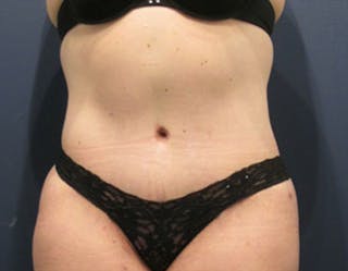 Tummy Tuck Before & After Gallery - Patient 174164440 - Image 2