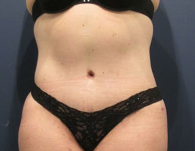 Tummy Tuck Before & After Gallery - Patient 174164440 - Image 2