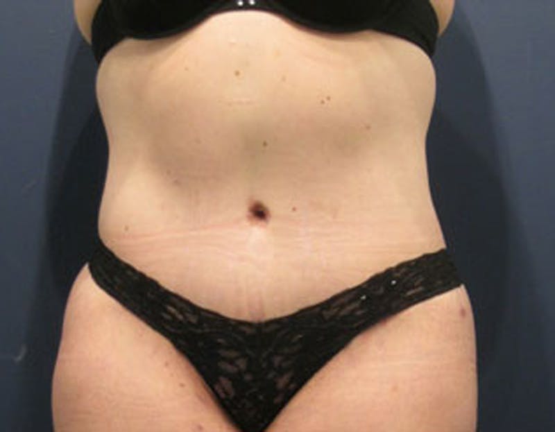 Tummy Tuck Before & After Gallery - Patient 174164440 - Image 2
