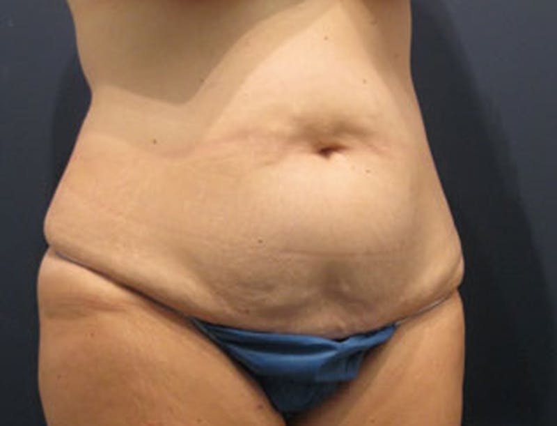 Tummy Tuck Before & After Gallery - Patient 174164440 - Image 3