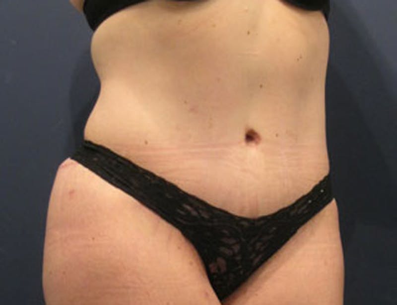Tummy Tuck Before & After Gallery - Patient 174164440 - Image 4