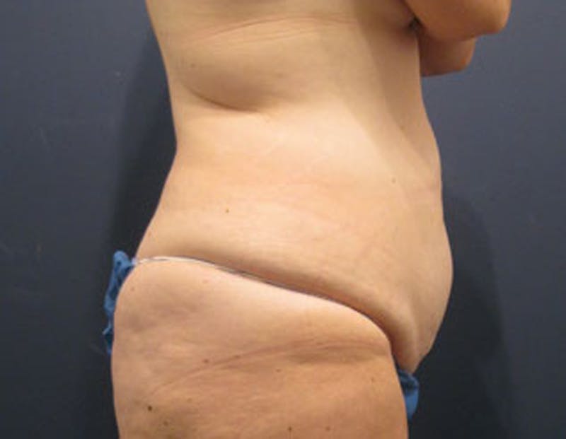 Tummy Tuck Before & After Gallery - Patient 174164440 - Image 5