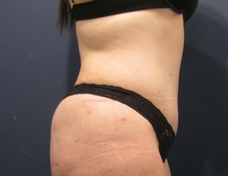 Tummy Tuck Before & After Gallery - Patient 174164440 - Image 6