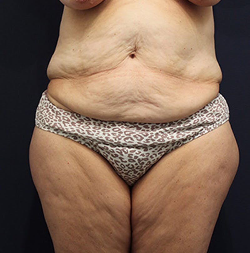 Tummy Tuck Before & After Gallery - Patient 174164446 - Image 1