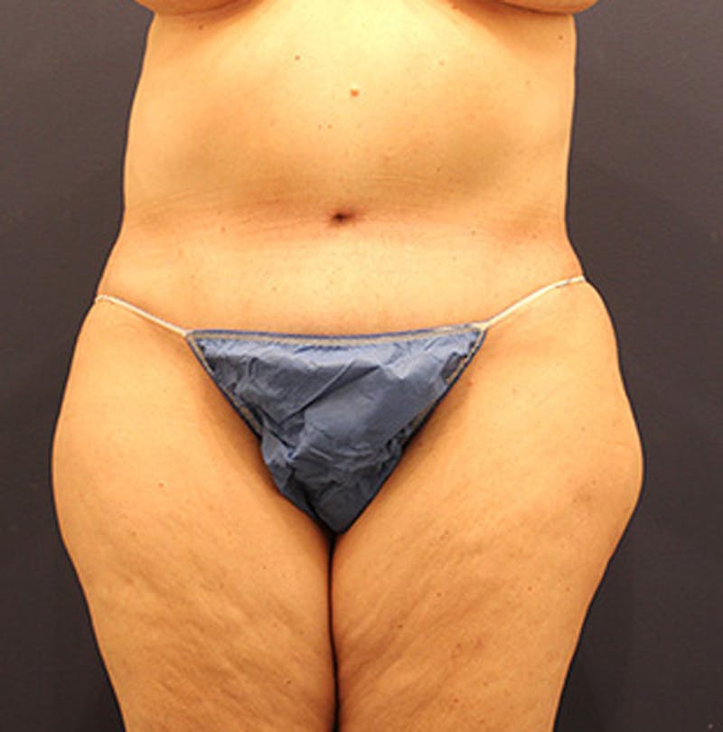 Tummy Tuck Before & After Gallery - Patient 174164446 - Image 2