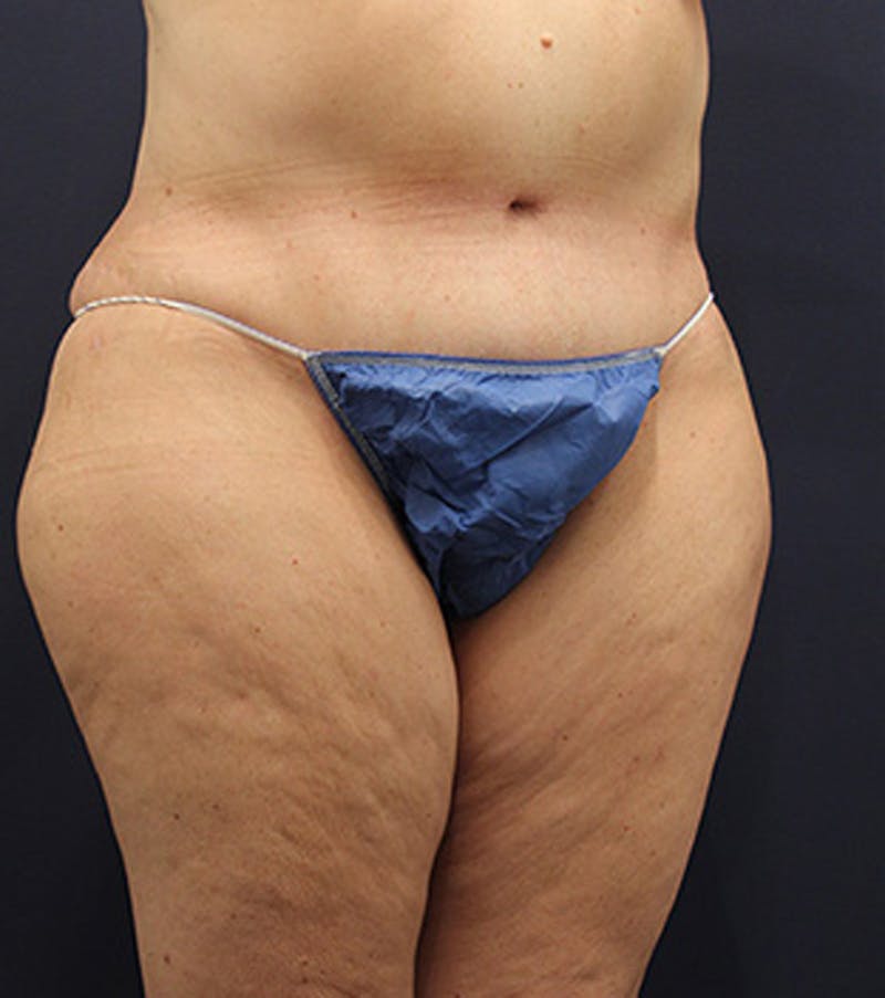 Tummy Tuck Before & After Gallery - Patient 174164446 - Image 4