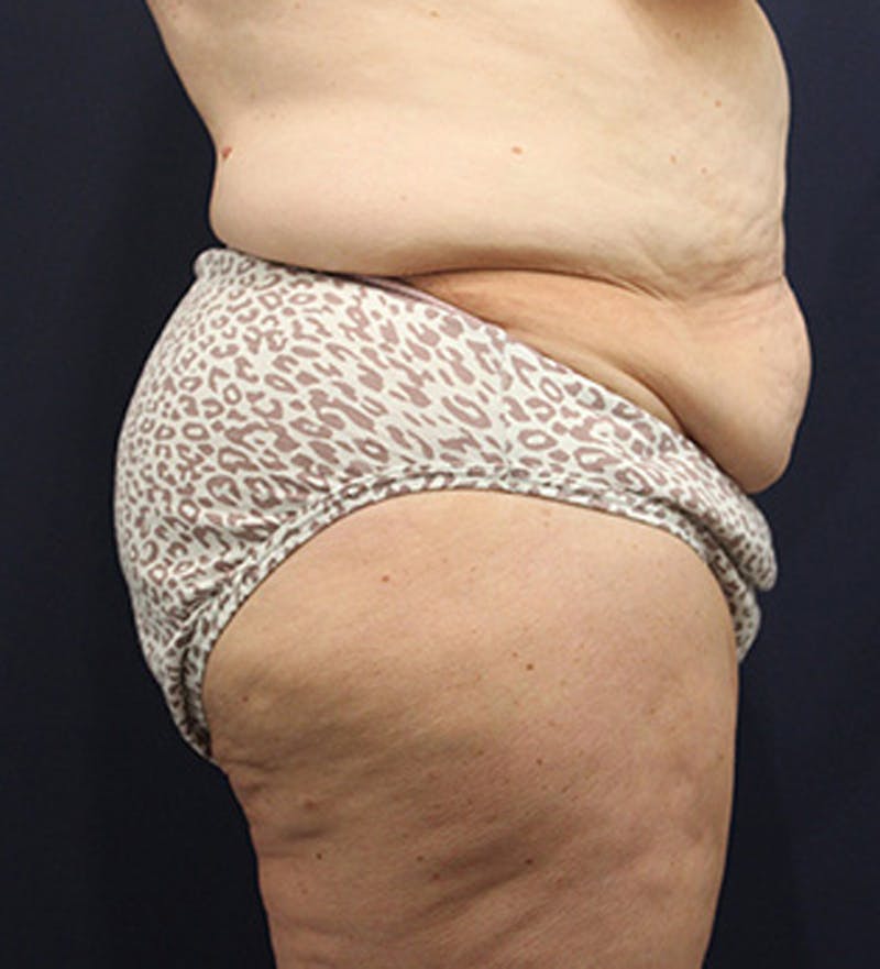 Tummy Tuck Before & After Gallery - Patient 174164446 - Image 5
