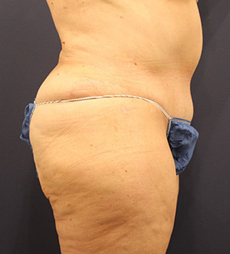 Tummy Tuck Before & After Gallery - Patient 174164446 - Image 6