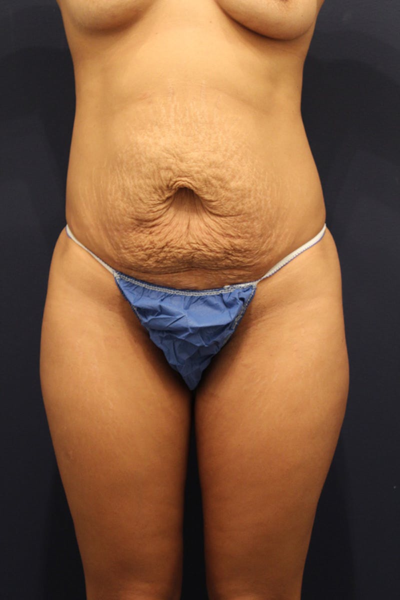 Tummy Tuck Before & After Gallery - Patient 174164451 - Image 1