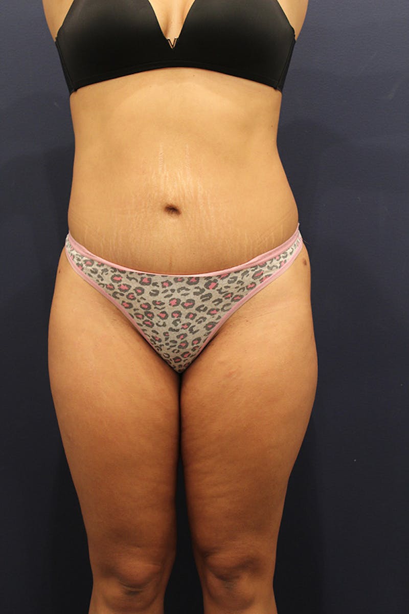 Tummy Tuck Before & After Gallery - Patient 174164451 - Image 2