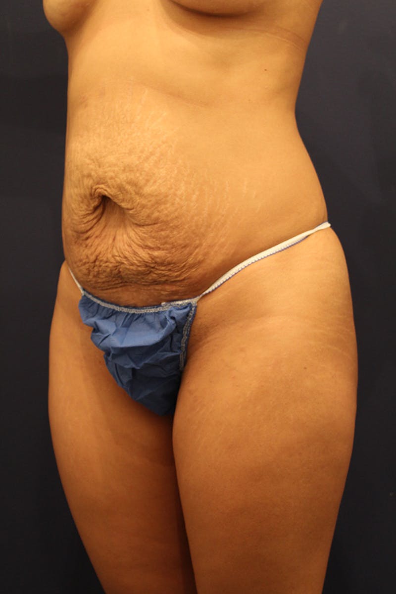 Tummy Tuck Before & After Gallery - Patient 174164451 - Image 3