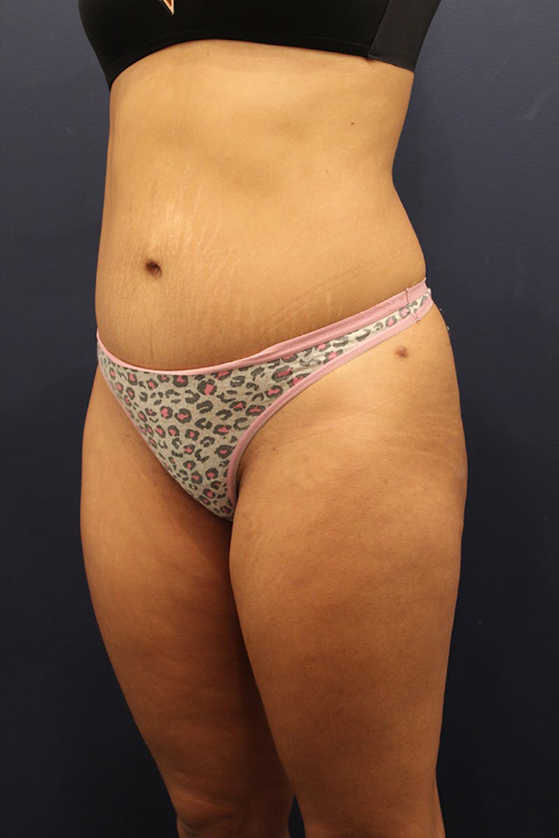 Tummy Tuck Before & After Gallery - Patient 174164451 - Image 4