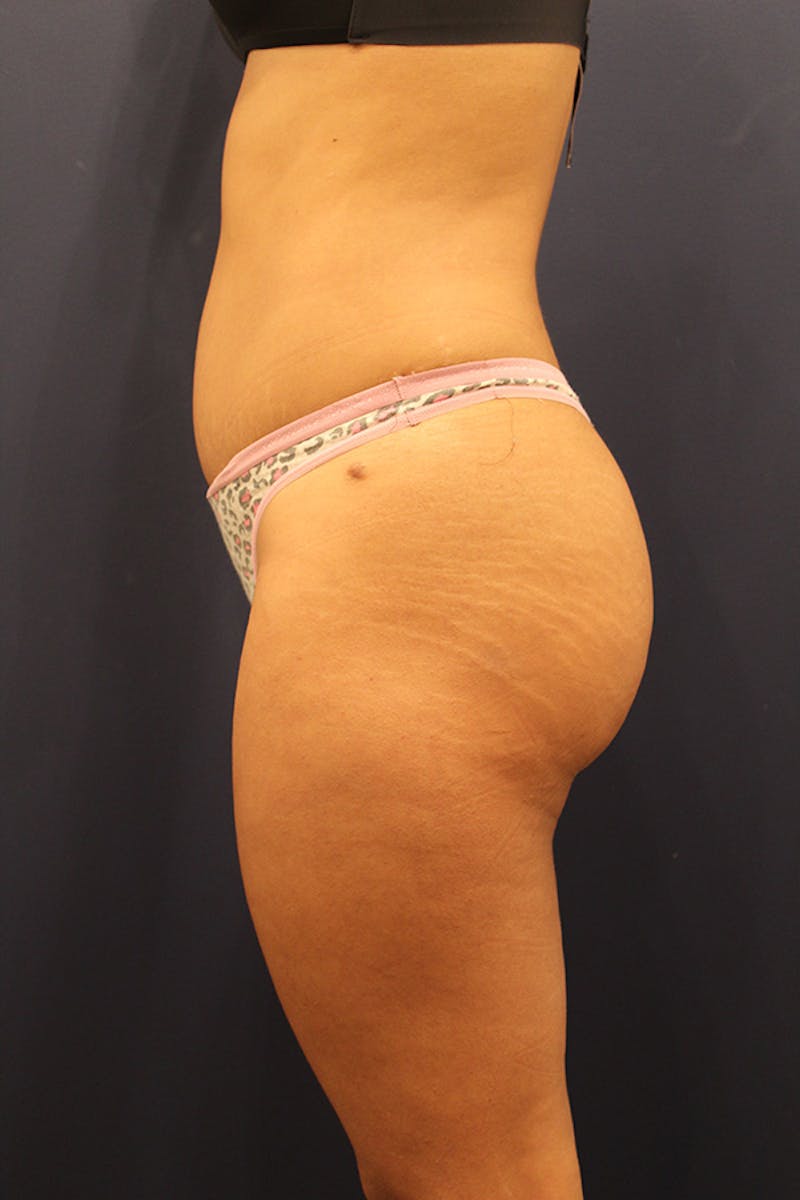 Tummy Tuck Before & After Gallery - Patient 174164451 - Image 6