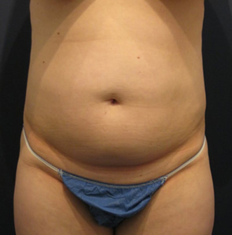 Tummy Tuck Before & After Gallery - Patient 174164455 - Image 1