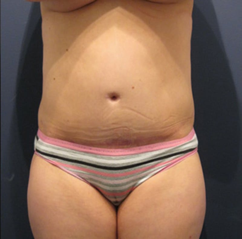 Tummy Tuck Before & After Gallery - Patient 174164455 - Image 2