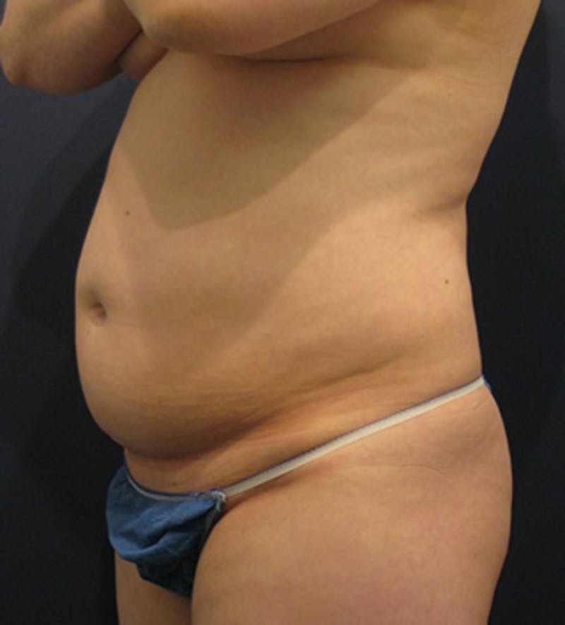 Tummy Tuck Before & After Gallery - Patient 174164455 - Image 3