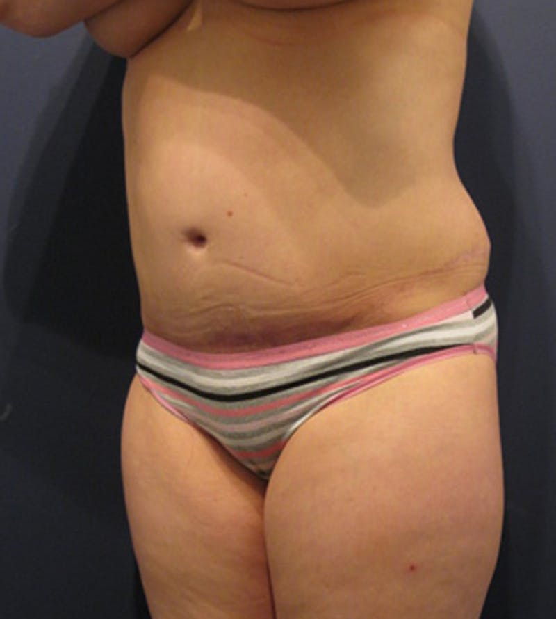 Tummy Tuck Before & After Gallery - Patient 174164455 - Image 4