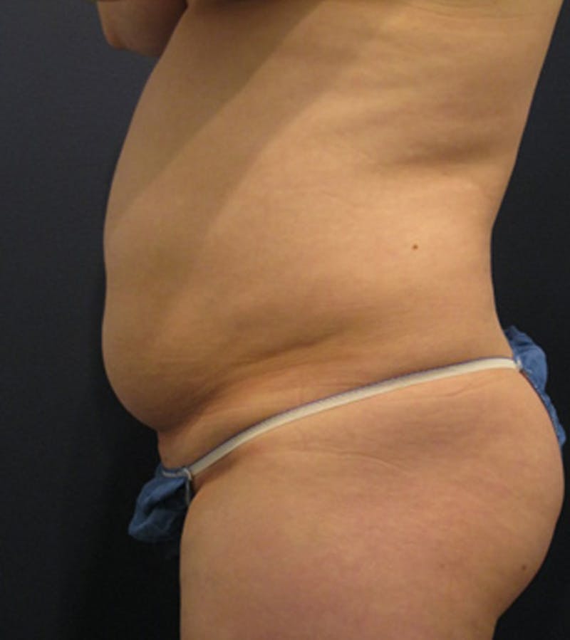 Tummy Tuck Before & After Gallery - Patient 174164455 - Image 5